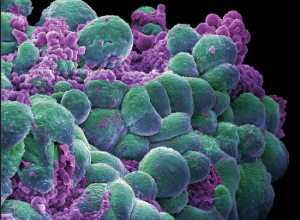 Breast Cancer Cells 