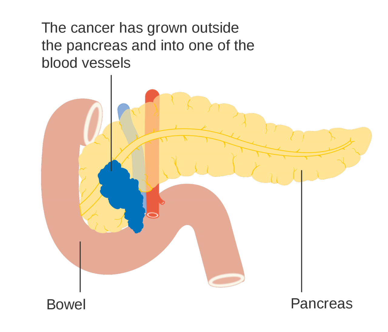 Pancreatic Cancer Bioquakes